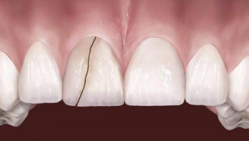 Материал для заделывания трещин в зубах. Что делать, если треснул передний или боковой зуб?