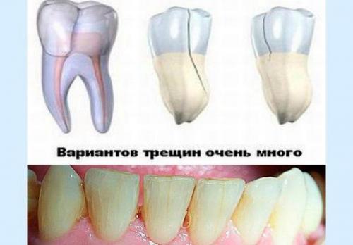 Материал для заделывания трещин в зубах. Что делать, если треснул передний или боковой зуб?